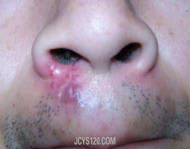 带状疱疹专业情况 什么是疱疹 这些情况就是疱疹了