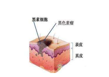 黑色素瘤病因 黑色素瘤能活多久 它的病因是什么