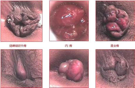 痔疮治疗方法偏方 治疗痔疮的偏方 痔疮的最佳治疗方法 治疗痔疮的偏方