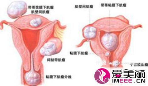 卵巢囊肿影响怀孕吗 卵巢囊肿影响怀孕原因