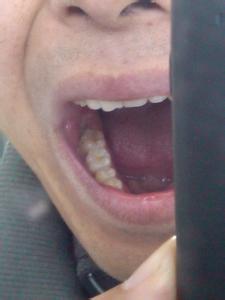 智齿拔掉后牙洞发臭 是不是拔掉智齿就不臭？