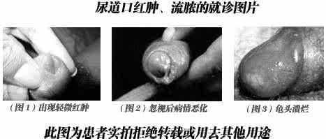 尿道口红肿是怎么了 尿道口红肿 尿道口红肿是怎么造成的