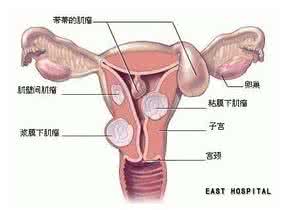 子宫肌瘤会导致不孕吗 子宫肌瘤会导致贫血、便秘!还会遗传?