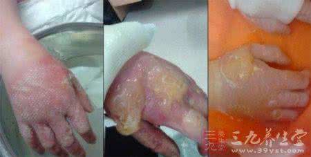 大猪草 只因碰了一下“大猪草”双手差点截肢