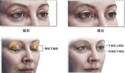 快速消除黑眼圈多少钱 去黑眼圈大概多少钱 怎样快速消除黑眼圈