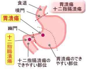 胃十二指肠溃疡治疗 图文：治疗胃及十二指肠溃疡验方