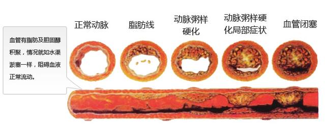 毛细血管容易破裂 血管细容易得什么病？