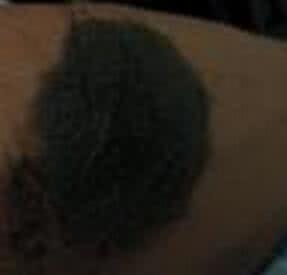 黑色胎记有什么危害 黑色胎记有什么危害 有胎记智商高？放屁！别害了你孩子！