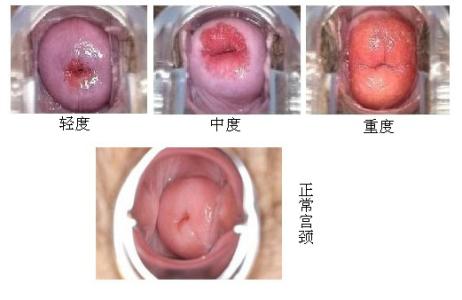 下面有异味怎么处理 宫颈糜烂怎么治疗 女人那里病了竟有异味