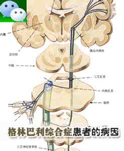 格林巴利综合症病因 格林巴利综合症症状 格林巴利综合症的病因