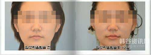 嘴角上扬整形 42件让你嘴角上扬的事