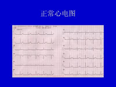 正常心电图波形图示 正常心电图