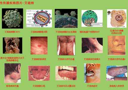 艾滋病传播途径 艾滋病初期症状 艾滋病 传播途径