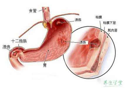 治疗胃溃疡最好的偏方 胃溃疡