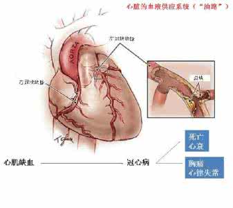 冠状动脉造影剂是什么 冠状动脉造影 什么是冠状动脉造影