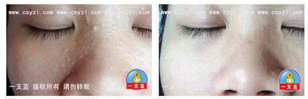 多发性毛发上皮瘤治疗 毛发上皮瘤 毛发上皮瘤怎么治疗