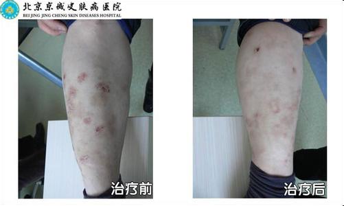 银屑病患者必读 银屑病患者怀孕怎么办 银屑病患者怎么治疗比较好