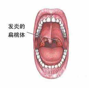 扁桃腺炎的饮食疗法 咽喉炎、扁桃腺炎效验方（转载）