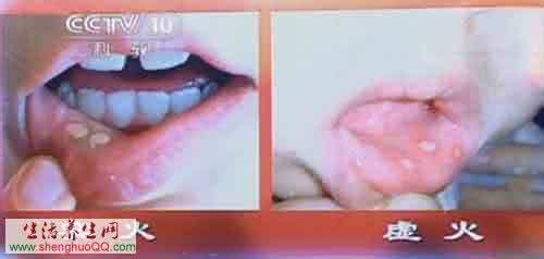 健康之路口腔溃疡 健康之路20150525视频和笔记:李乾构,口腔溃疡之痛(上)