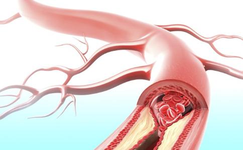 怎样预防动脉硬化 原来预防动脉硬化这么简单