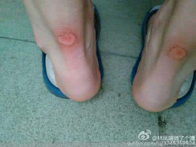 穿鞋磨脚后跟怎么办 【生活诀窍】新鞋磨脚怎么办？穿鞋小窍门