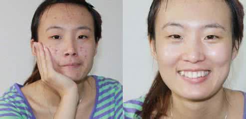 青春痘中西医治疗 青春痘怎么治疗 中西医一起帮你治青春痘