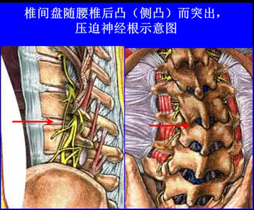 腰椎间盘突出症治疗 图文:治疗腰椎间盘突出症的秘方