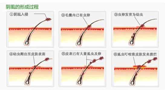 阴虱病治疗方法 阴虱病治疗方法 5个方法防好阴虱病