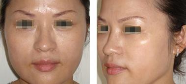 眼角纹除皱 八字纹 眼角除皱手术