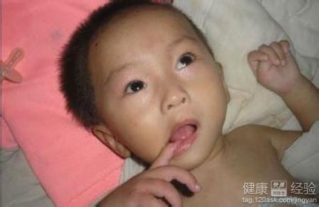 婴幼儿脑瘫的表现 脑瘫的原因  脑瘫的表现