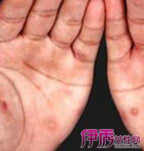 艾滋病潜伏期多长时间 艾滋病潜伏期多长时间 艾滋病潜伏期多长