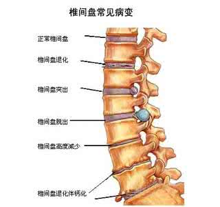 颈椎间盘突出如何治疗 颈椎间盘突出 颈椎间盘突出如何治疗