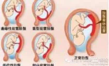 中央性前置胎盘的睡姿 中央性前置胎盘的症状