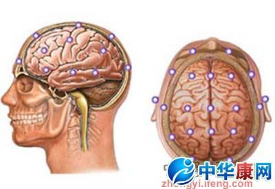 高血压脑病的临床表现 高血压脑病的临床表现 高血压脑病的食疗方法