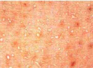 毛囊炎的症状图片 毛囊炎的症状