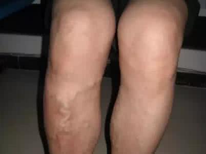 静脉曲张怎么治疗 静脉曲张怎么治疗 银屑病患者怎么治疗