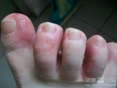 脚气病的治疗方法 什么是脚气病?如何治疗?