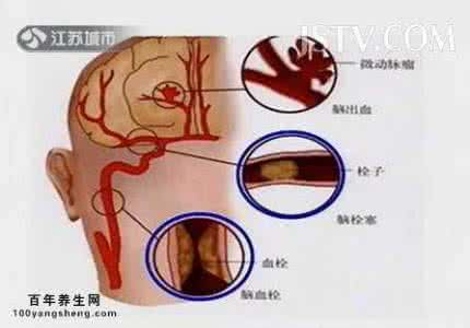心梗脑梗 心梗、脑梗、脑出血的信号,防脑梗脑出血的10 个窍门