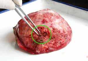 肝癌最好治疗方法 肝癌晚期治疗方法 肝癌晚期吃什么好