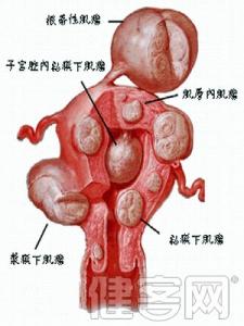宫颈肌瘤的治疗方法 宫颈肌瘤 如何预防宫颈肌瘤