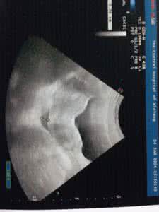 小腹胀痛白带多 白带多小腹胀痛是什么样原因引起的