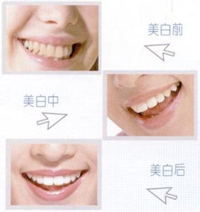 怎样使牙齿美白 怎样使牙齿变白 如何使牙齿变白快速美白牙齿方法大全