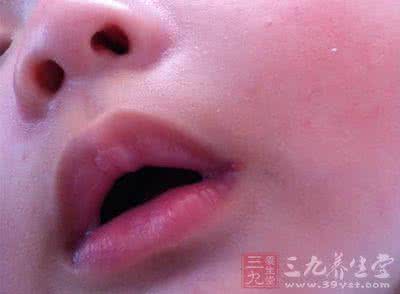 治疗口腔溃疡小妙招 小孩口腔溃疡怎么办 小孩口腔溃疡怎么办 8大妙招来帮你