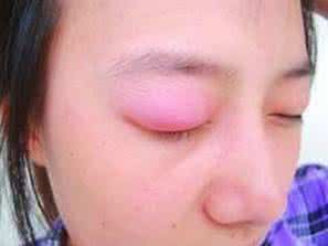 眼睑板腺堵塞原因 眼睑浮肿有哪些原因