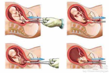 怀孕多久能做人流手术 怀孕多久能做人流手术必须了解
