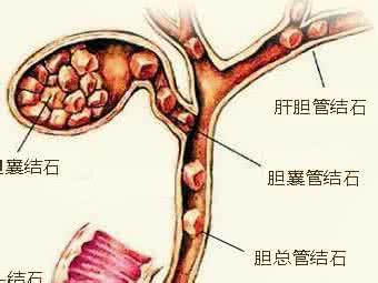 胆囊息肉能自愈吗 什么是胆囊息肉