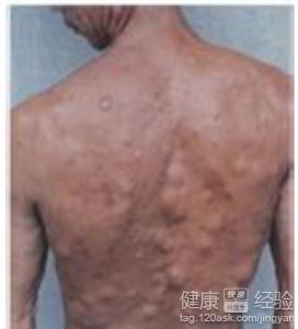 治疗多发性脂肪瘤偏方 治多发性脂肪瘤神方