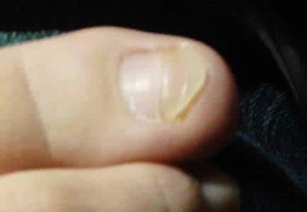 脚指甲变厚用什么药 脚趾甲变厚是什么原因引起的