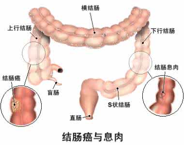 大肠癌与结直肠癌 大肠癌（结直肠癌）早期有哪些信号？