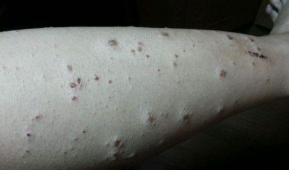 疥疮的症状图 疥疮的症状